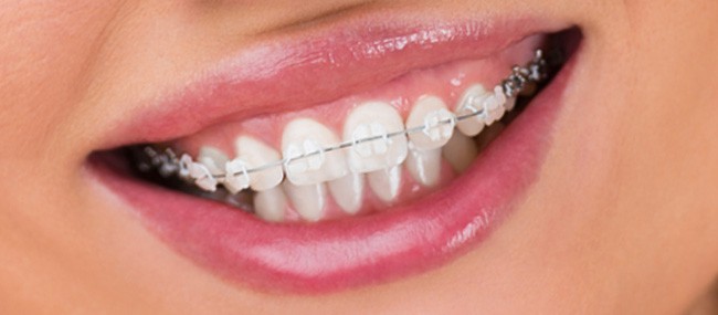 Ortodontia em adultos