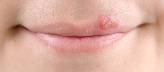 Herpes labial