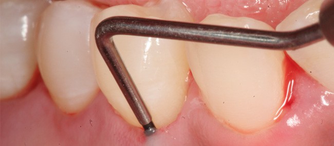 Cirurgia plástica periodontal